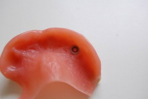 acrylic denture from riverside Dental practice