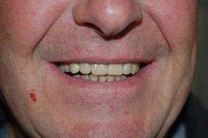 A good quality denture