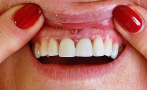 Smile Rehabilaitation at Riverside Dental Practice Braunton North Devon