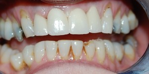 After replacing front tooth with an implant at Riverside Dental Practice Braunton