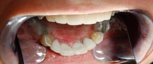 After Before treating lower front teeth with replacement ceramic crowns Riverside Dental practice Braunton