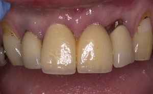 before and after pictures of an implant retained replacement front tooth Riverside Dental Practice Braunton