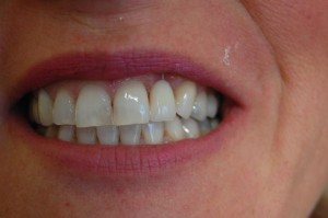 Replacing missing teeth with an adhesive bridge at Riverside Dental Practice, Braunton, Devon UK.