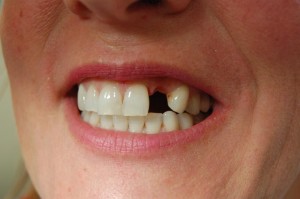 Replacing missing teeth with an adhesive bridge at Riverside Dental Practice, Braunton, Devon UK.