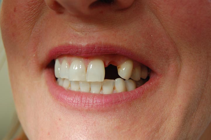 After picture showing missing tooth replaced with an adhesive bridge. 