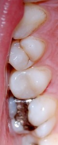  Replacing discoloured fillings at Riverside Dental Practice Braunton, Devon, UK.