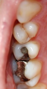  Replacing discoloured fillings at Riverside Dental Practice Braunton, Devon, UK. 