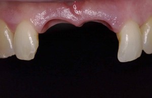 Replacing missing teeth with implants at Riverside Dental Practice Braunton