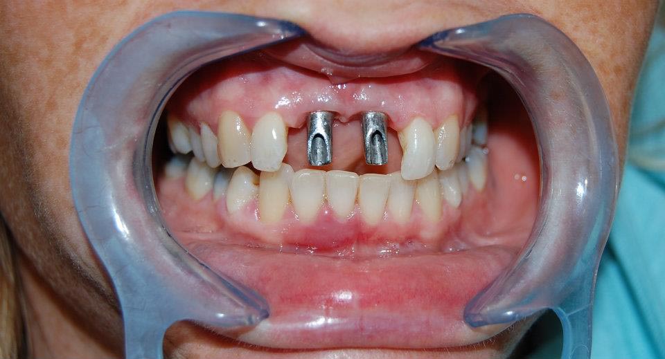 Front teeth missing two Treatment Options