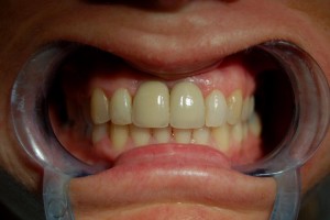 Replacing missing teeth with implants at Riverside Dental Practice Braunton