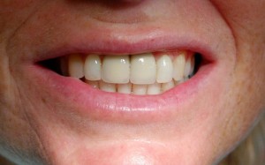 Replacing missing teeth with implants at Riverside Dental Practice Braunton