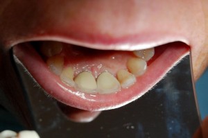 Replacing missing teeth with implants at Riverside Dental Practice Braunton